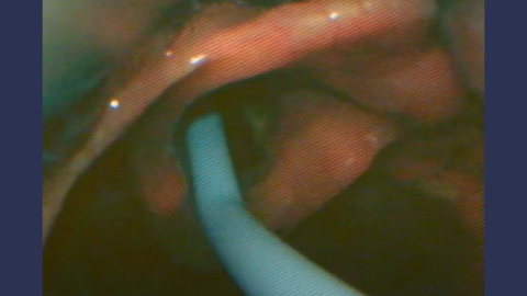 Foundations of Video Laryngoscopy